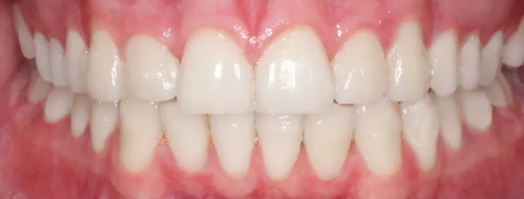een close up van een gebit